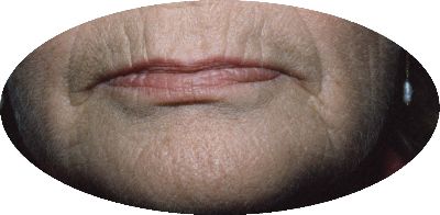 wrinkles